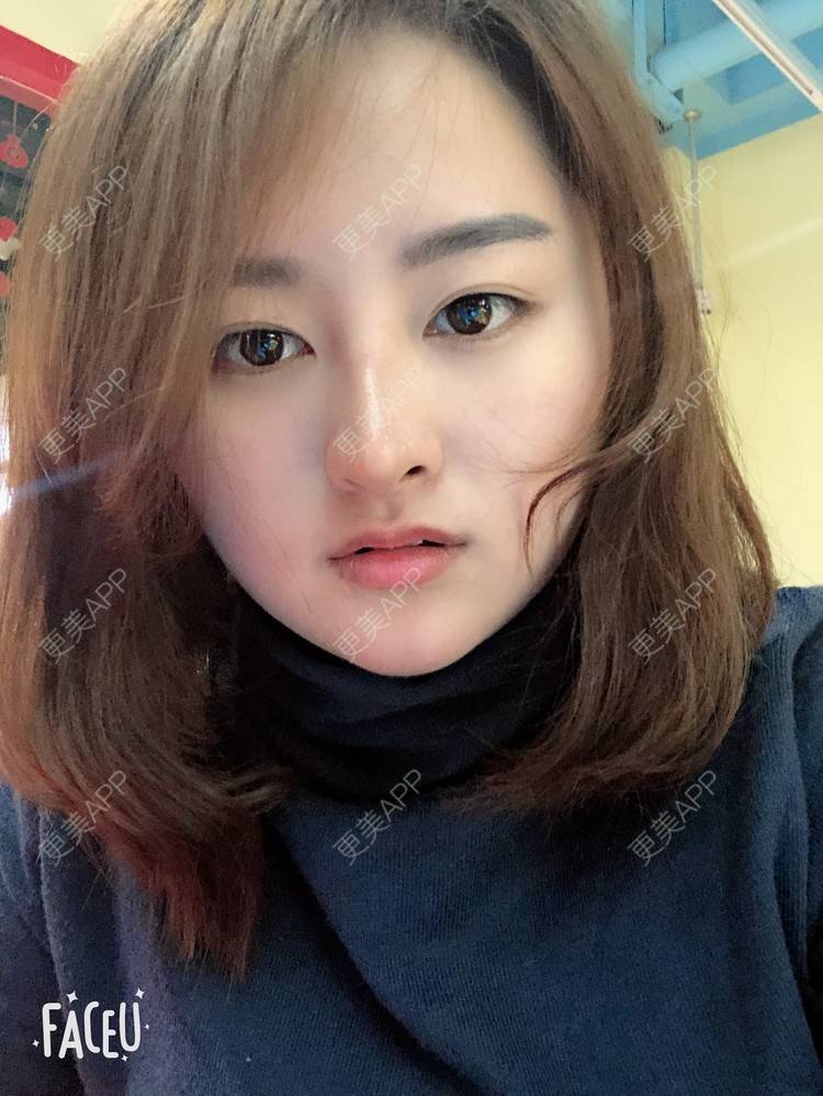 更美 - 浑身上下的肋软骨隆鼻经验 | 更美研究所 | 杭州 | 肋软骨隆鼻 | 隆鼻