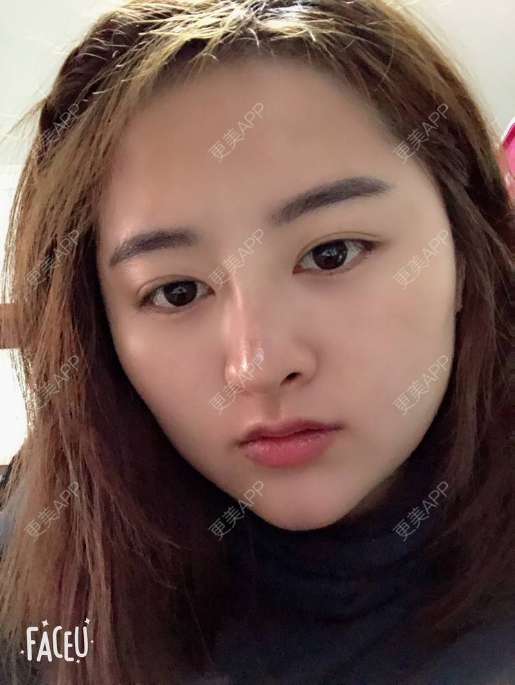 更美 - 浑身上下的肋软骨隆鼻经验 | 更美研究所 | 杭州 | 肋软骨隆鼻 | 隆鼻