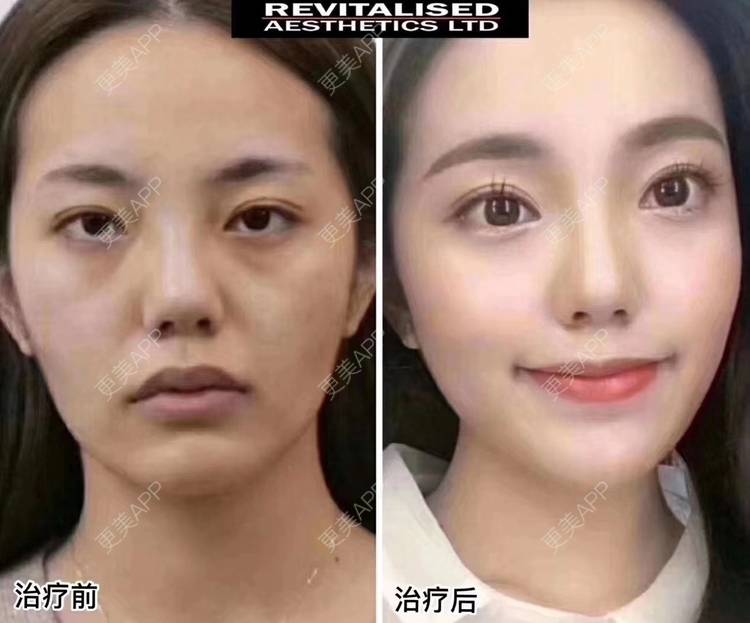 更美 - 女神来了🌻🌻的胶原蛋白丰太阳穴经验 | 注射美白 | 水光项目 | 胶原蛋白丰太阳穴 | 胶原蛋白丰下巴 | 胶原蛋白改善法令纹