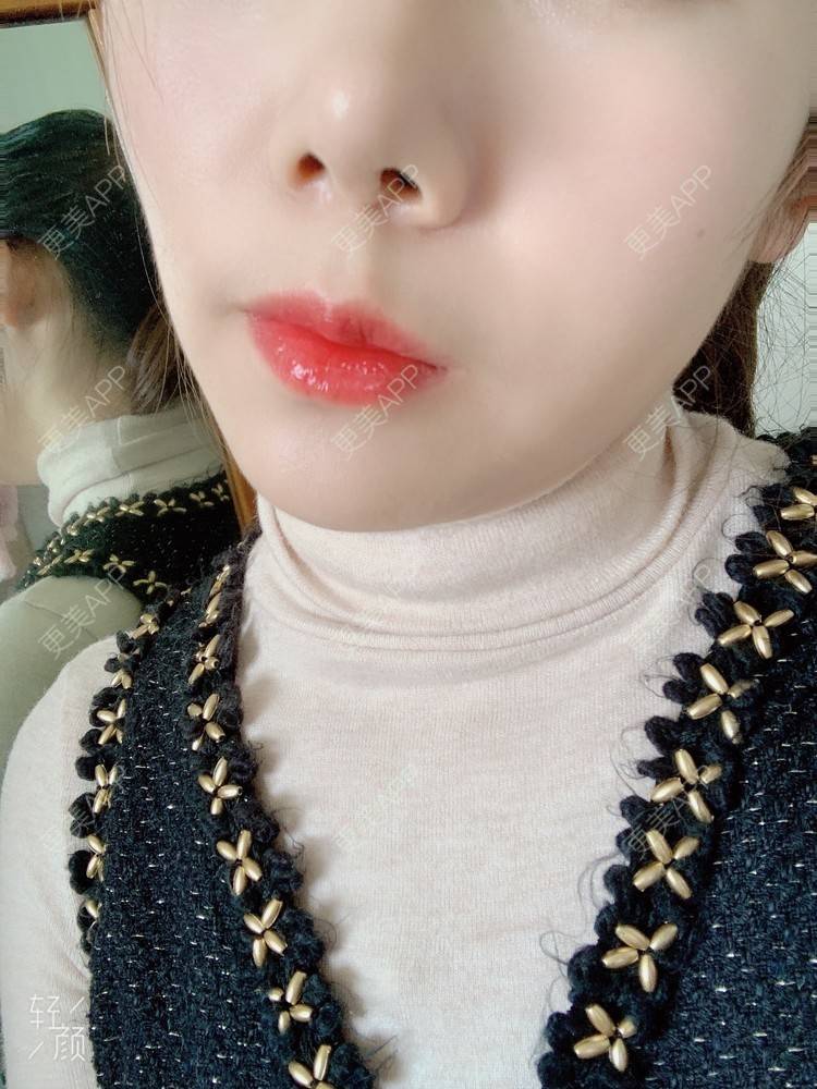 更美 - 浃浃！的厚唇改薄经验 | 厚唇改薄 | 上海