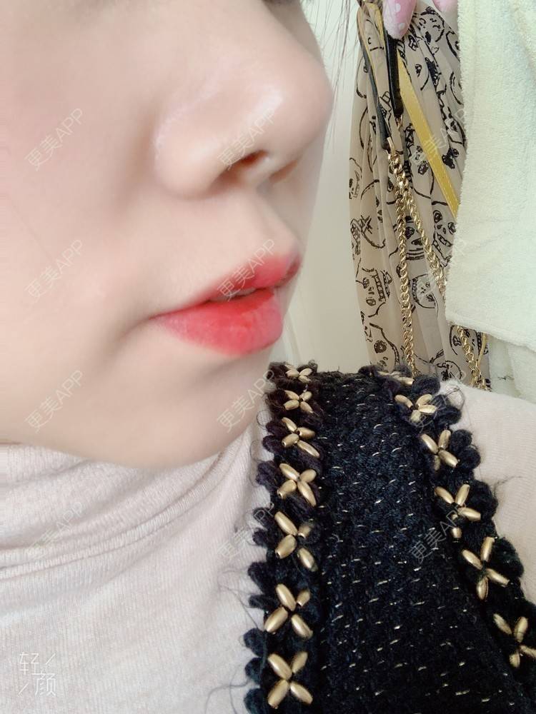 更美 - 浃浃！的厚唇改薄经验 | 厚唇改薄 | 上海