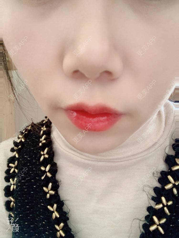 更美 - 浃浃！的厚唇改薄经验 | 厚唇改薄 | 上海