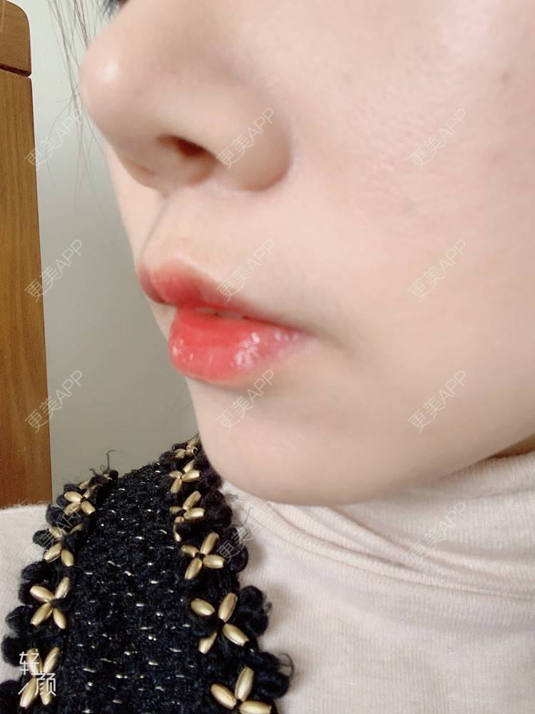 更美 - 浃浃！的厚唇改薄经验 | 厚唇改薄 | 上海