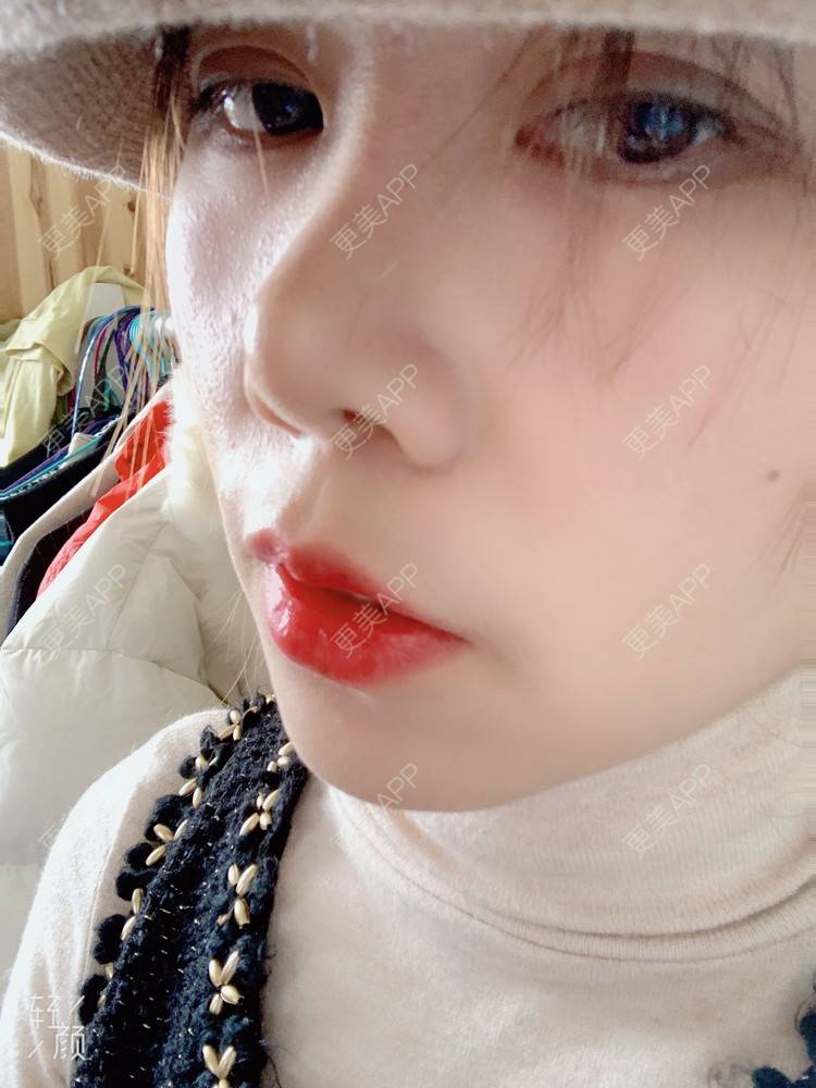 更美 - 浃浃！的厚唇改薄经验 | 厚唇改薄 | 上海