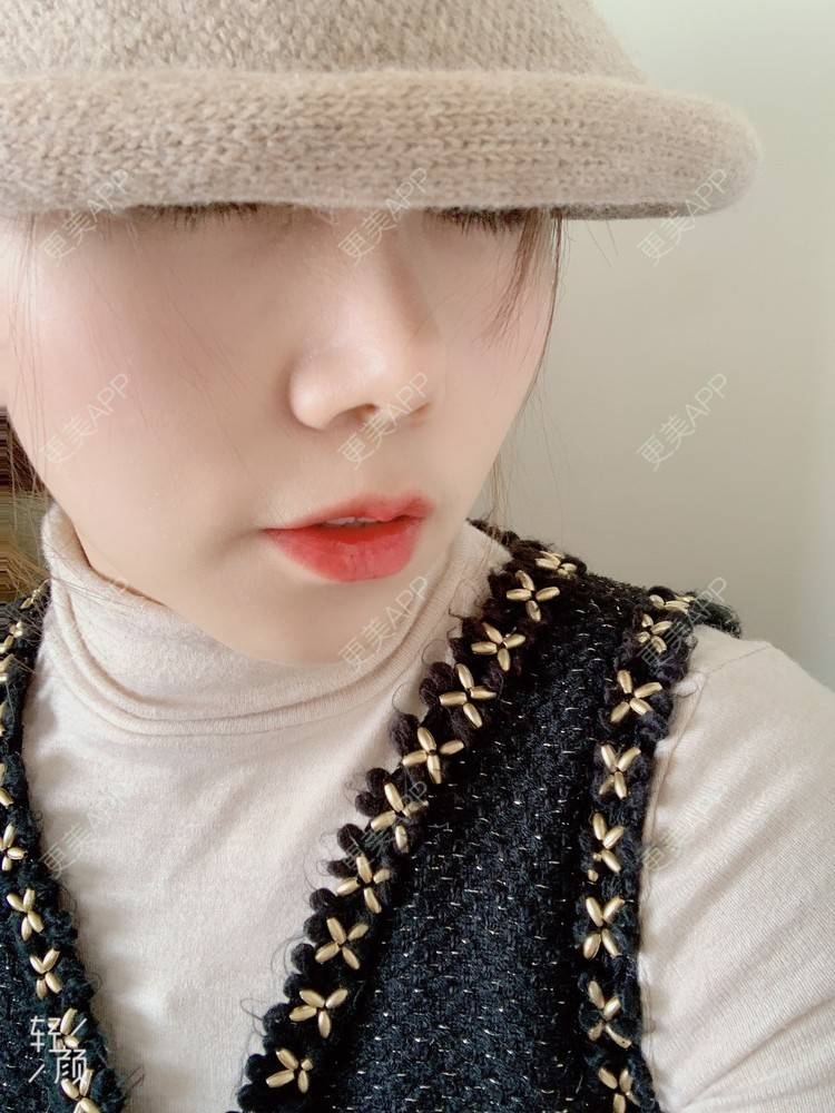 更美 - 浃浃！的厚唇改薄经验 | 厚唇改薄 | 上海