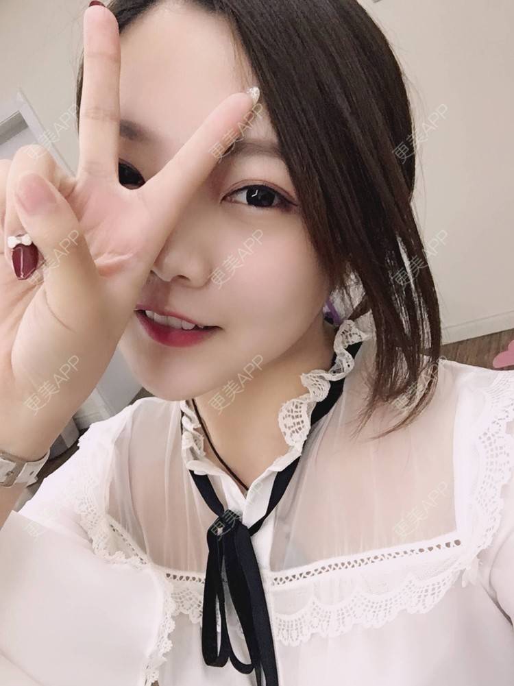 更美 - 45979002的双眼皮经验 | 双眼皮 | 眼部多项 | 双眼皮修复 | 开内眼角 | 埋线双眼皮 | 隆鼻 | 除皱瘦脸 | 深圳 | 半永久妆