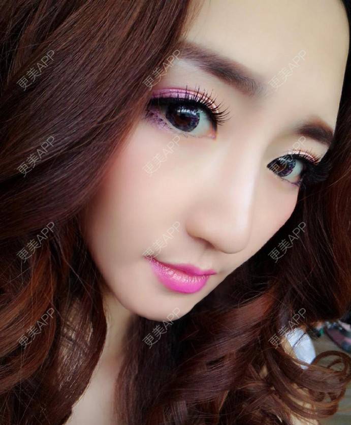 更美 - 更美用户cA33i6DxJX的玻尿酸下巴经验 | 玻尿酸下巴 | 上饶