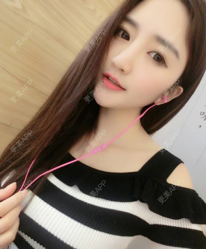 更美 - 更美用户cA33i6DxJX的玻尿酸下巴经验 | 玻尿酸下巴 | 上饶