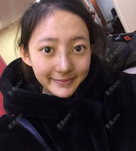 更美 - 高静 医生的肋软骨隆鼻经验 | 肋软骨隆鼻 | 南宁