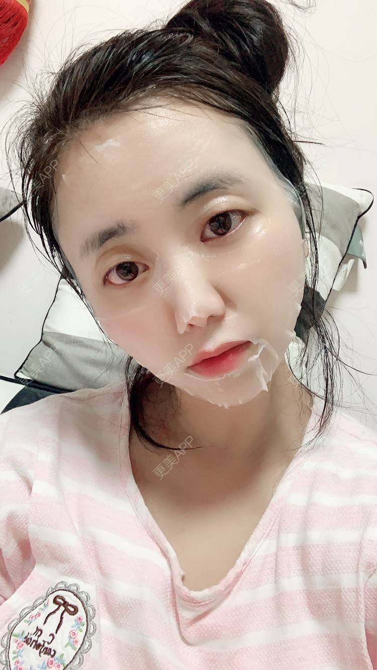 更美 - 筱汐颜的自体脂肪填充泪沟经验 | 自体脂肪填充泪沟 | 自体脂肪丰苹果肌 | 自体脂肪丰面颊 | 自体脂肪丰太阳穴 | 自体脂肪丰额头 | 重庆 | 自体脂肪全面部填充