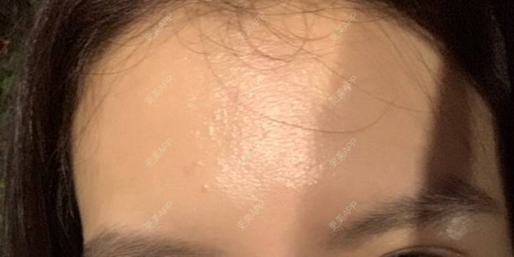 更美 - 更美用户CUVg97dlGa的微针水光经验 | 重庆 | 微针水光