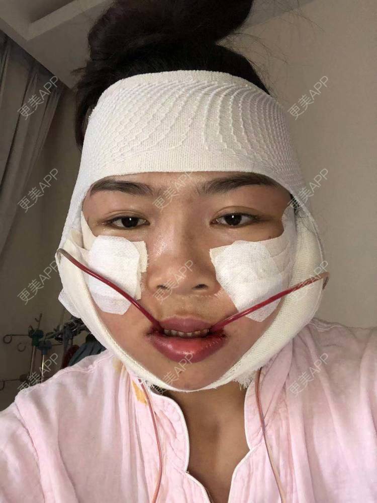 下颌角切除术手术_fate丿大爱★换_术后252天__更美整形