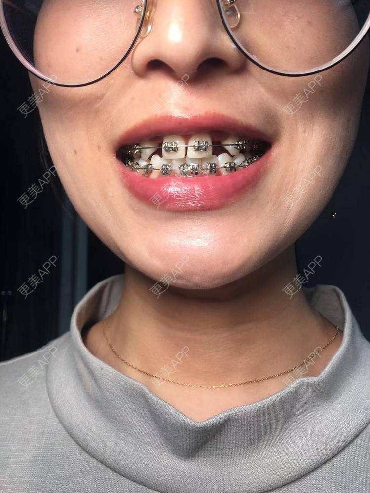 更美 - Zvkk的牙齿矫正经验 | 更美研究所 | 杭州 | 牙齿矫正