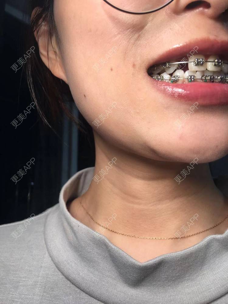 更美 - Zvkk的牙齿矫正经验 | 更美研究所 | 杭州 | 牙齿矫正