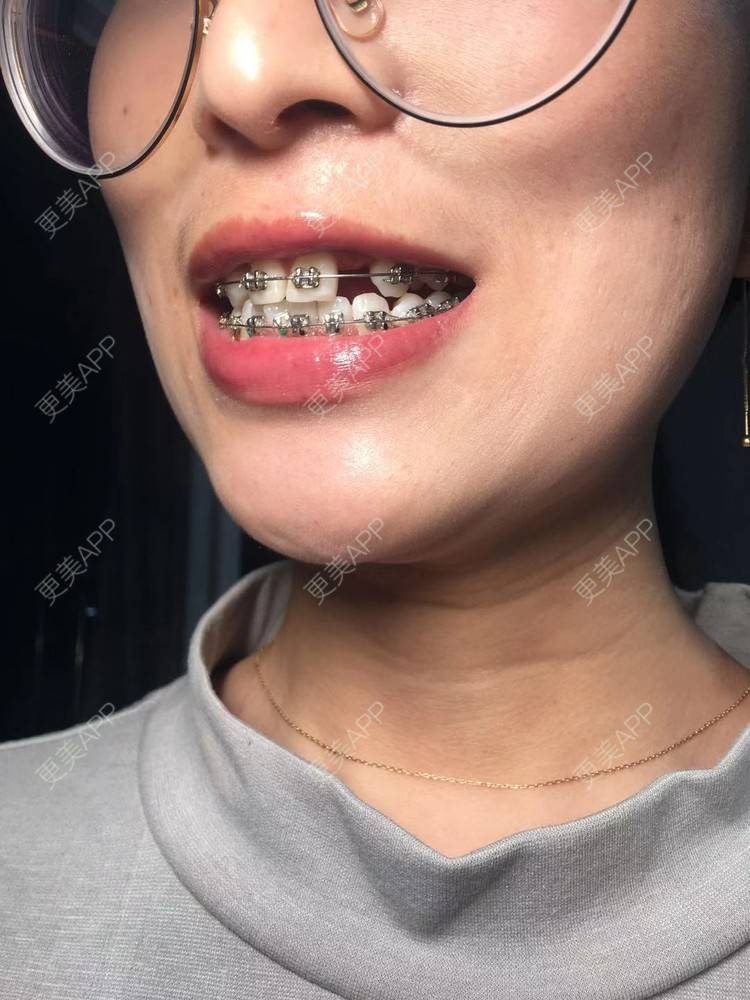 更美 - Zvkk的牙齿矫正经验 | 更美研究所 | 杭州 | 牙齿矫正