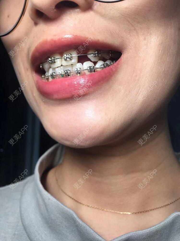 更美 - Zvkk的牙齿矫正经验 | 更美研究所 | 杭州 | 牙齿矫正