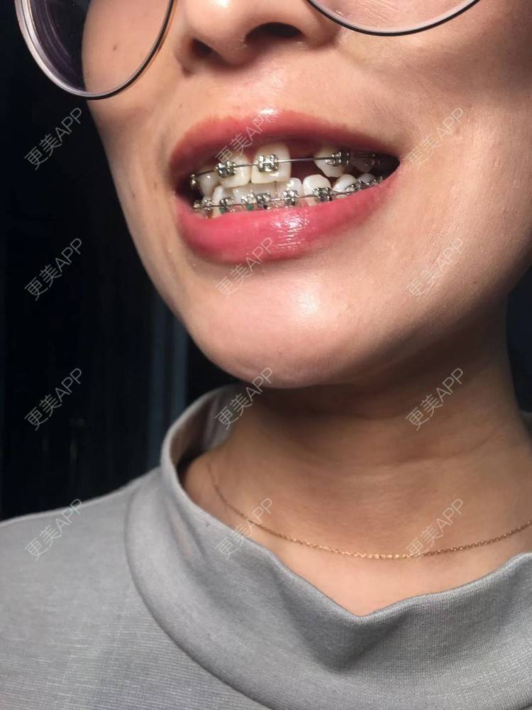 更美 - Zvkk的牙齿矫正经验 | 更美研究所 | 杭州 | 牙齿矫正