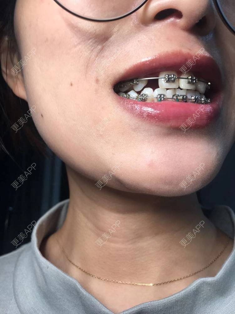 更美 - Zvkk的牙齿矫正经验 | 更美研究所 | 杭州 | 牙齿矫正
