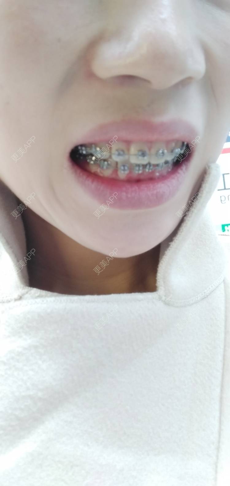 更美 - 看看介绍的牙齿矫正经验 | 视频日记 | 杭州 | 更美研究所 | 牙齿矫正