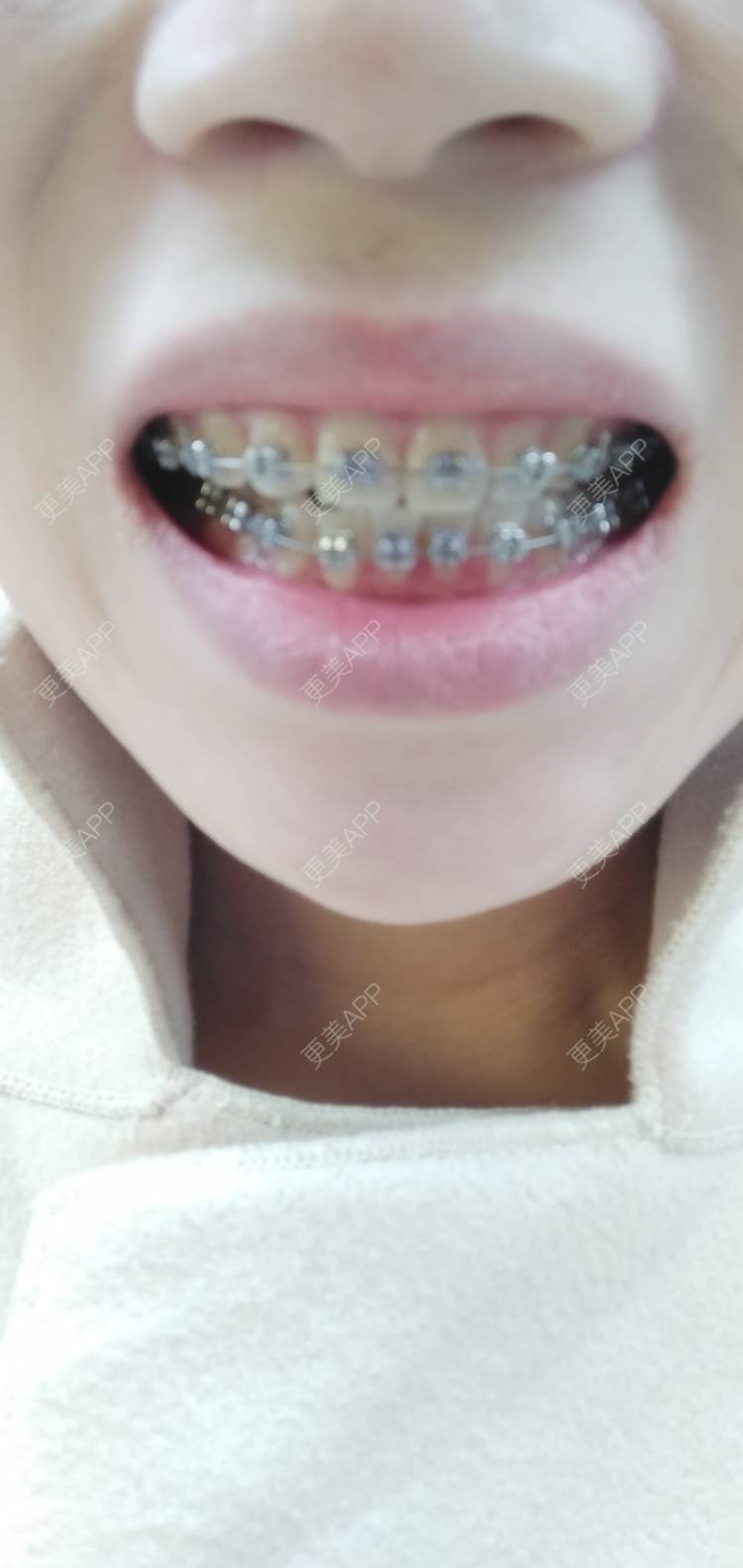 更美 - 看看介绍的牙齿矫正经验 | 视频日记 | 杭州 | 更美研究所 | 牙齿矫正