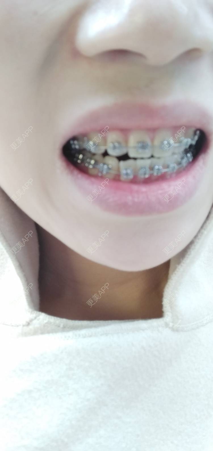更美 - 看看介绍的牙齿矫正经验 | 视频日记 | 杭州 | 更美研究所 | 牙齿矫正