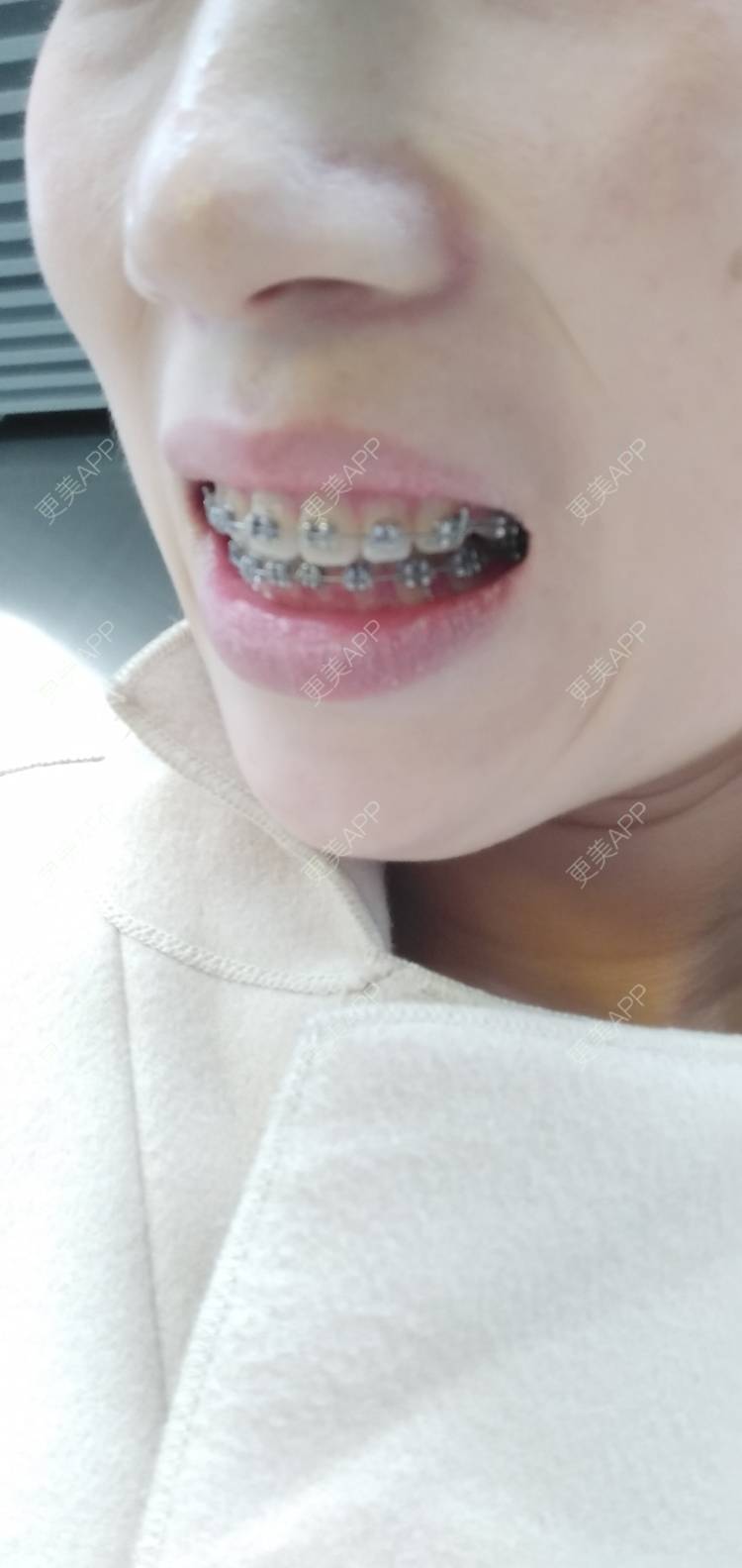 更美 - 看看介绍的牙齿矫正经验 | 视频日记 | 杭州 | 更美研究所 | 牙齿矫正