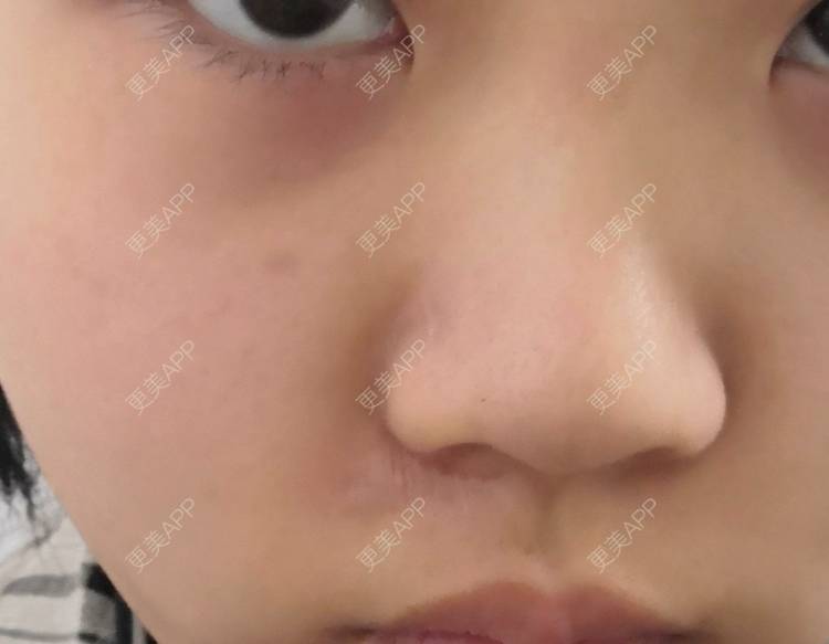 更美 - 更美用户D7fDWf5pP6的激光淡疤经验 | 上海 | 激光淡疤