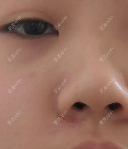 更美 - 更美用户D7fDWf5pP6的激光淡疤经验 | 上海 | 激光淡疤