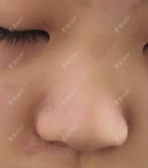 更美 - 更美用户D7fDWf5pP6的激光淡疤经验 | 上海 | 激光淡疤