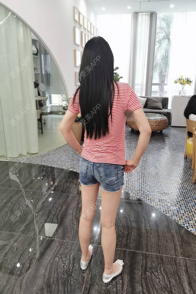 更美 - 巧克可可的腰腹吸脂经验 | 腰腹吸脂 | 背部吸脂 | 手臂吸脂 | 重庆