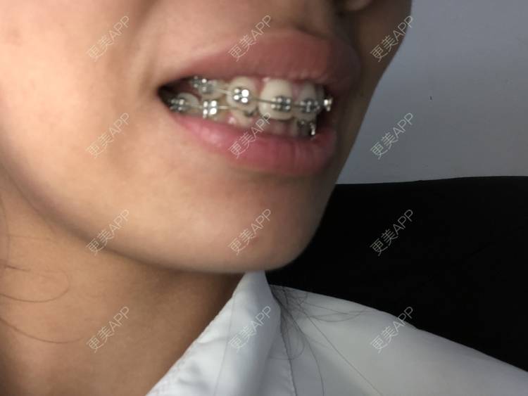 更美 - 来回顾一下的牙齿矫正经验 | 杭州 | 牙齿矫正 | 视频日记