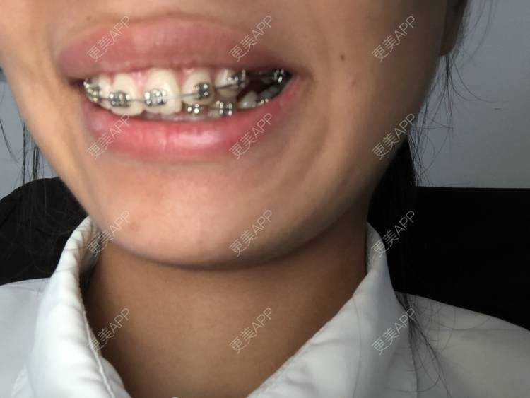 更美 - 来回顾一下的牙齿矫正经验 | 杭州 | 牙齿矫正 | 视频日记
