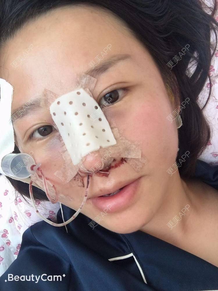 更美 - 更美用户1UKNNJxuNe的鼻部多项经验 | 耳软骨隆鼻 | 赣州 | 鼻部多项