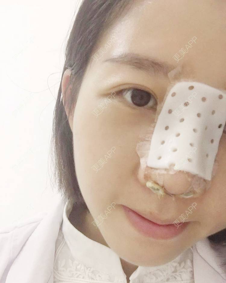 更美 - 更美用户1UKNNJxuNe的鼻部多项经验 | 耳软骨隆鼻 | 赣州 | 鼻部多项