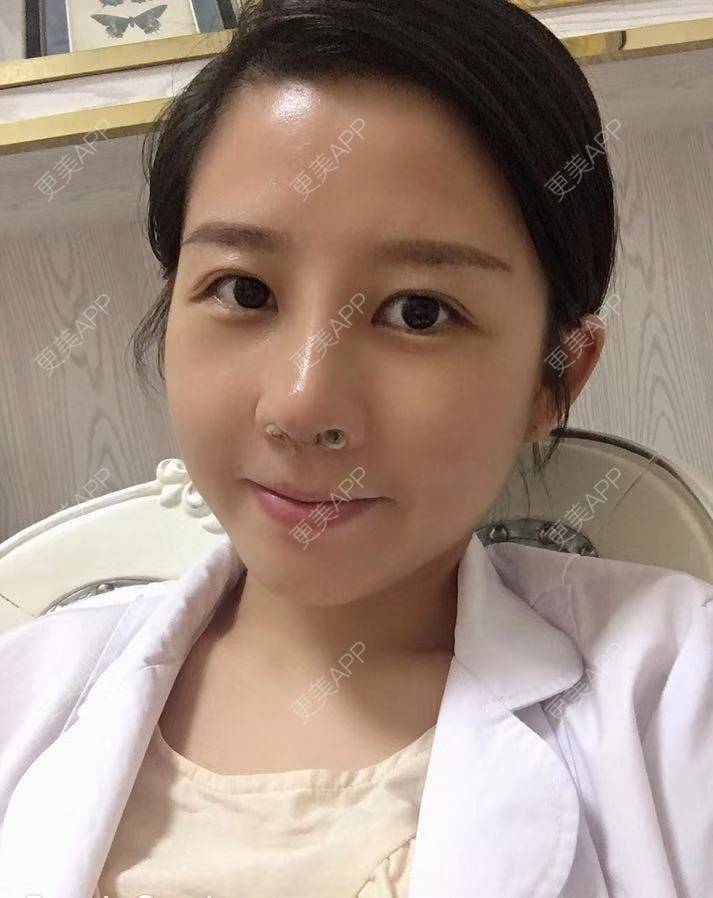 更美 - 更美用户1UKNNJxuNe的鼻部多项经验 | 耳软骨隆鼻 | 赣州 | 鼻部多项