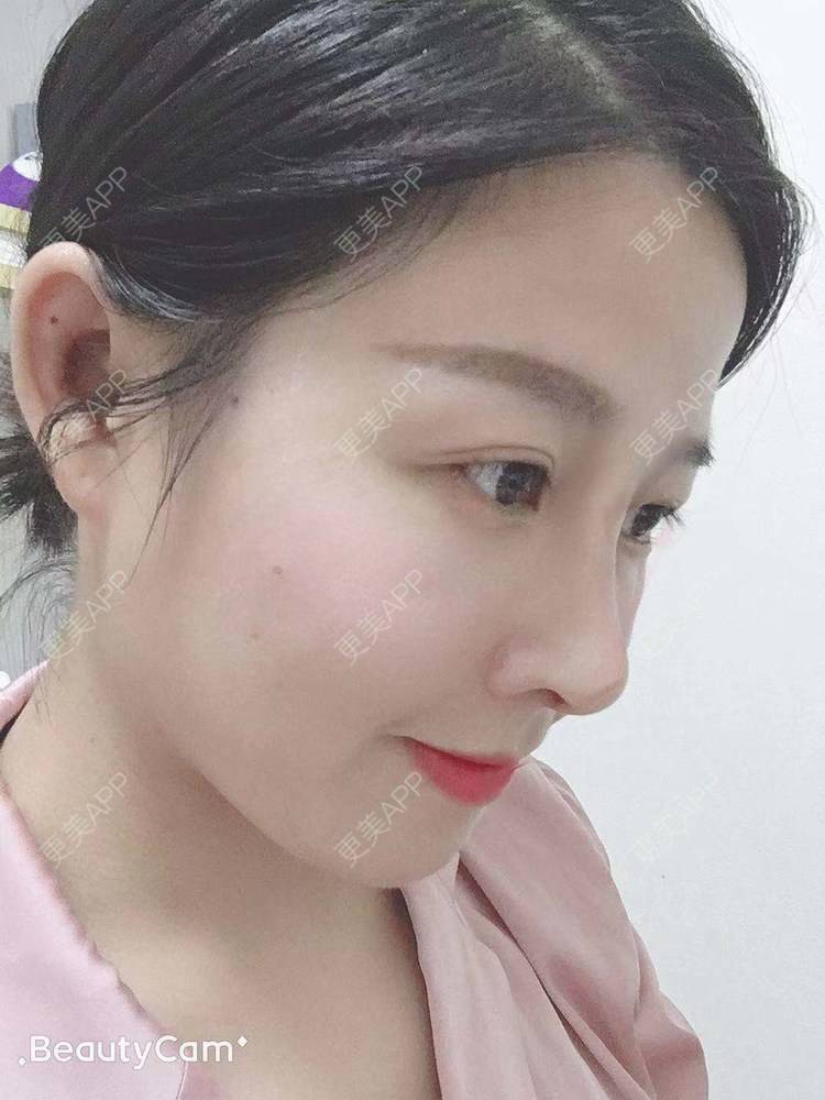 更美 - 更美用户1UKNNJxuNe的鼻部多项经验 | 耳软骨隆鼻 | 视频日记 | 赣州 | 鼻部多项