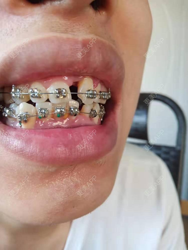 更美 - 规家家的牙齿矫正经验 | 更美研究所 | 杭州 | 牙齿矫正