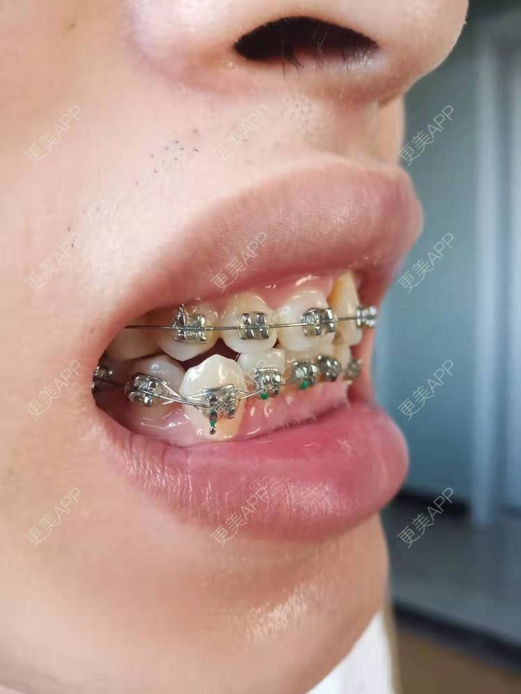 更美 - 规家家的牙齿矫正经验 | 更美研究所 | 杭州 | 牙齿矫正