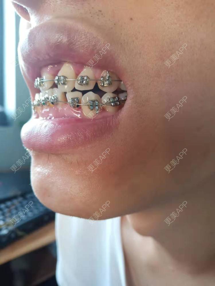 更美 - 规家家的牙齿矫正经验 | 更美研究所 | 杭州 | 牙齿矫正