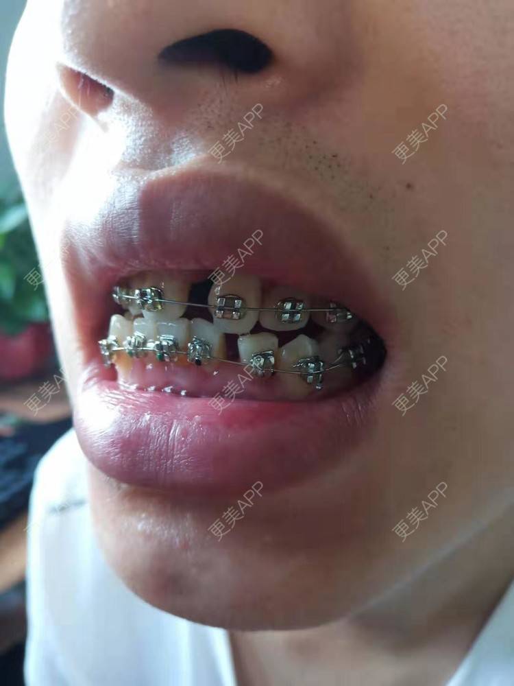 更美 - 规家家的牙齿矫正经验 | 更美研究所 | 杭州 | 牙齿矫正