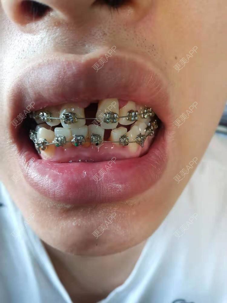 更美 - 规家家的牙齿矫正经验 | 更美研究所 | 杭州 | 牙齿矫正