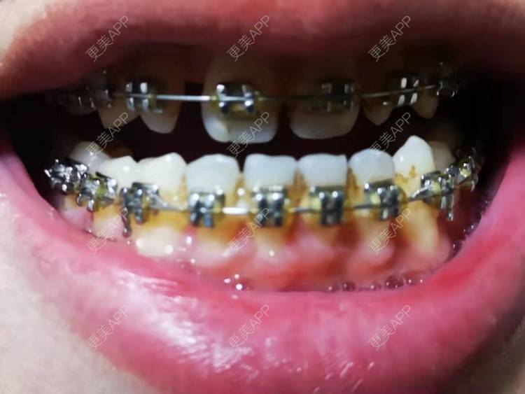 更美 - 阿福更好的牙齿矫正经验 | 更美研究所 | 杭州 | 牙齿矫正