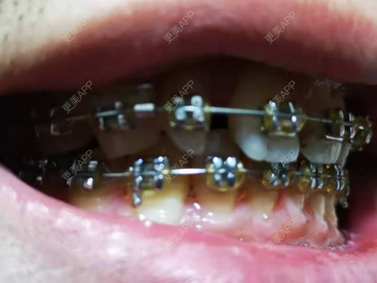 更美 - 阿福更好的牙齿矫正经验 | 更美研究所 | 杭州 | 牙齿矫正