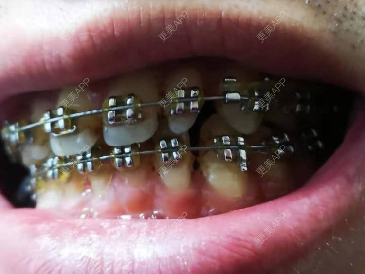 更美 - 阿福更好的牙齿矫正经验 | 更美研究所 | 杭州 | 牙齿矫正