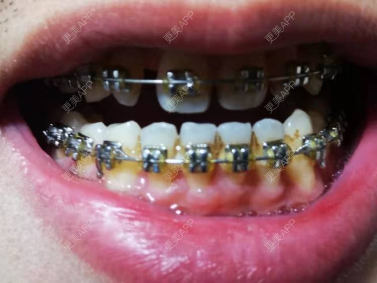 更美 - 阿福更好的牙齿矫正经验 | 更美研究所 | 杭州 | 牙齿矫正