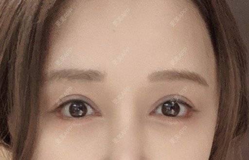更美 - Jennie🌸小悦儿的开外眼角经验 | 开外眼角 | 上海 | 提眉修复