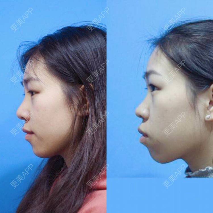 更美 - ii 就不必的牙齿矫正经验 | 更美研究所 | 杭州 | 牙齿矫正