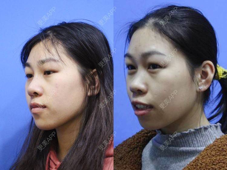 更美 - ii 就不必的牙齿矫正经验 | 更美研究所 | 杭州 | 牙齿矫正