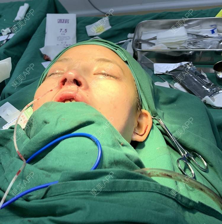 角角的唇腭裂修复日记