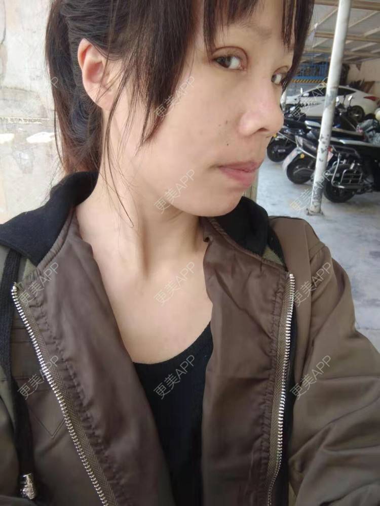 更美 - 我叫小芳的凸嘴矫正经验 | 凸嘴矫正 | 广州